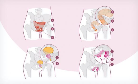 Diabetes und Sexualität Illustration