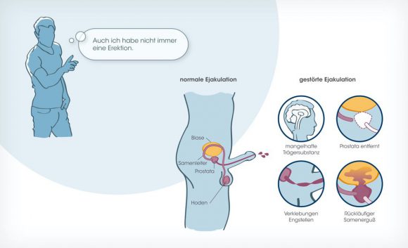 Diabetes und Sexualität Illustration